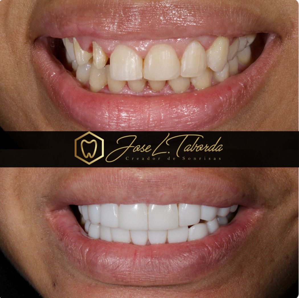 Carillas de porcelana premium - Resultado estético Dr. Taborda Cali