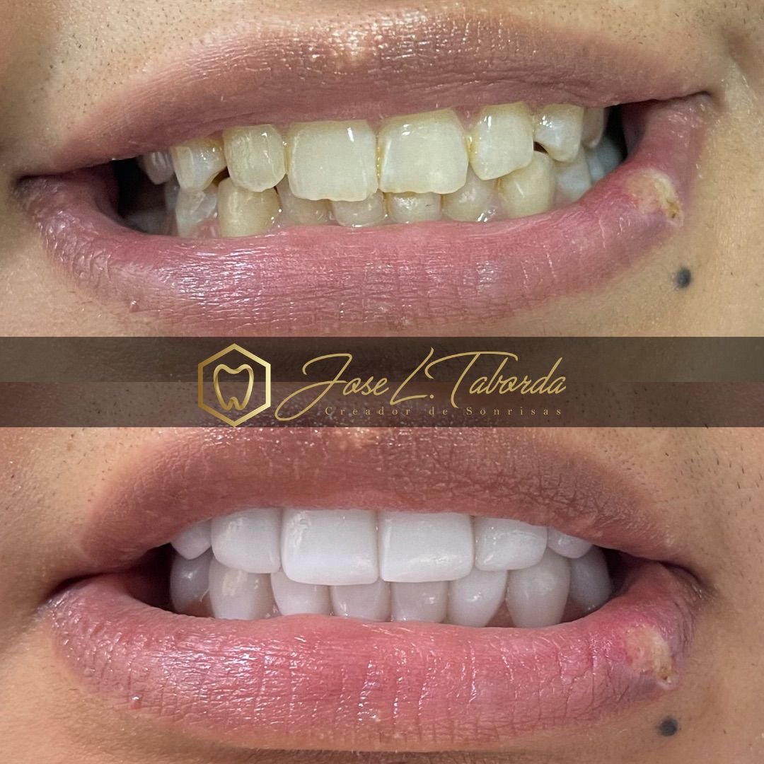 Diseño de sonrisa digital DSD - Transformación dental Dr. Taborda
