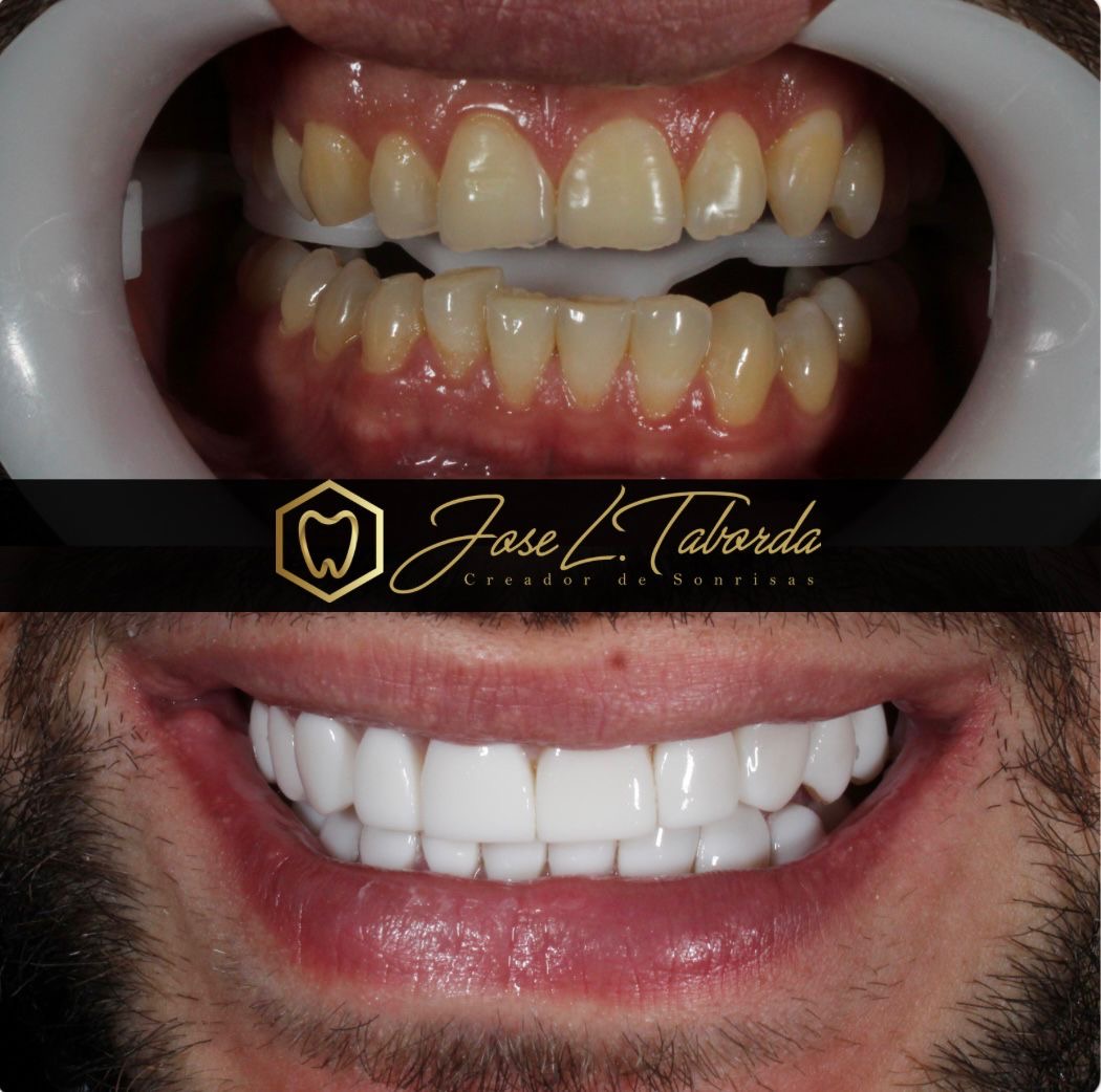 Odontología estética de alto nivel - Paciente real Dr. Taborda